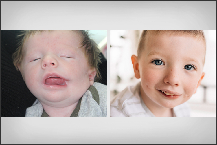 Cleft Lip Cleft Palate Craniofacial Surgery CAMC